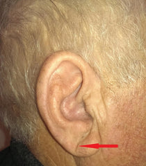 Image 1: Diagonal ear lobe crease. Image credit: Kamal R, Kausar K, Qavi AH, et al. Diagonal Earlobe Crease as a Significant Marker for Coronary Artery Disease: A Case-control Study. Cureus. 2017;9(2):e1013. Published 2017 Feb 5. doi:10.7759/cureus.1013. CC-BY 4.0