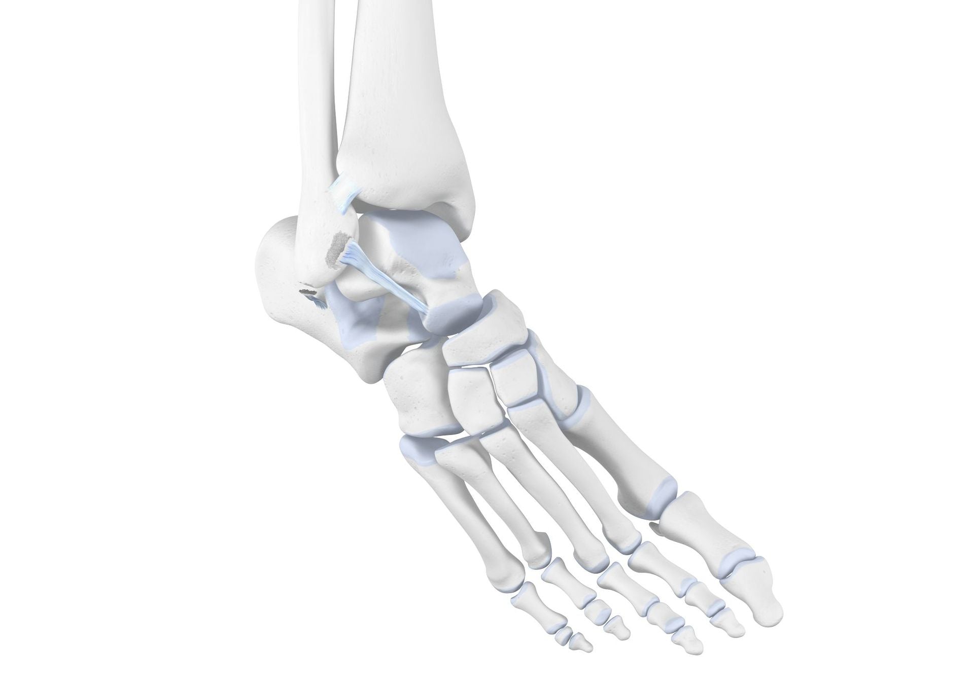 Ankle Distortions - Diagnosis, Treatment, & Prevention– Bauerfeind ANZ