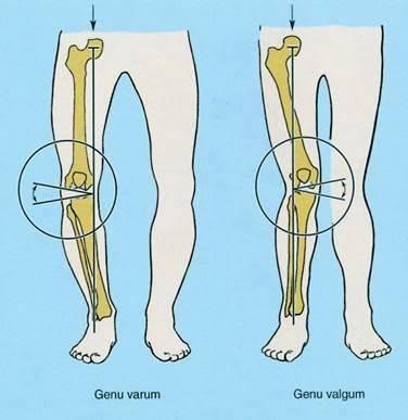 Diagrammes du genu varus et du genu valgus