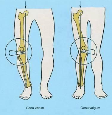 genu varus and genu valgus diagrams