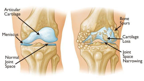 dommages internes à l'articulation du genou