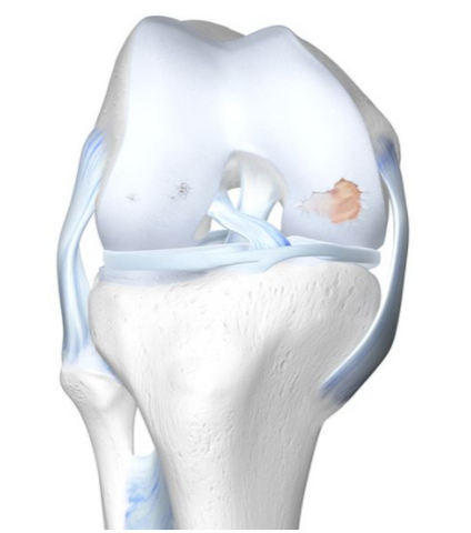 image de l'articulation du genou arthrose