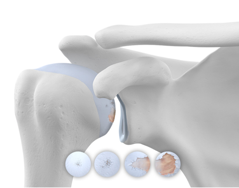 Image highlighting shoulder wear and tear associated with osteoarthritis 