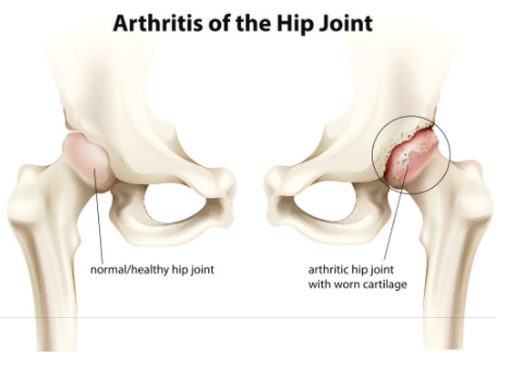 Schema of hip arthritis comparing hips