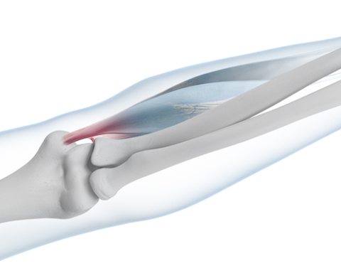 Skeletal diagram of the elbow highlighting in red the areas of pain