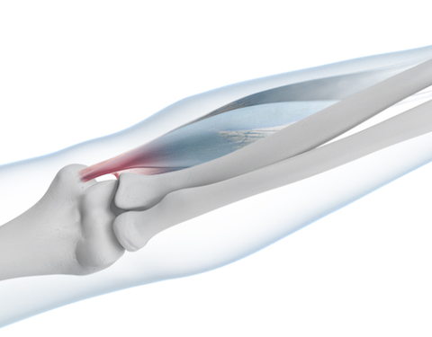 Skeletal diagram highlighting in red the area on the elbow where pain will occur