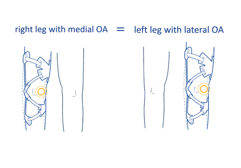Illustration showing how the GenuTrain OA osteoarthritis knee brace is worn on the right leg with medial OA and left leg with lateral OA on