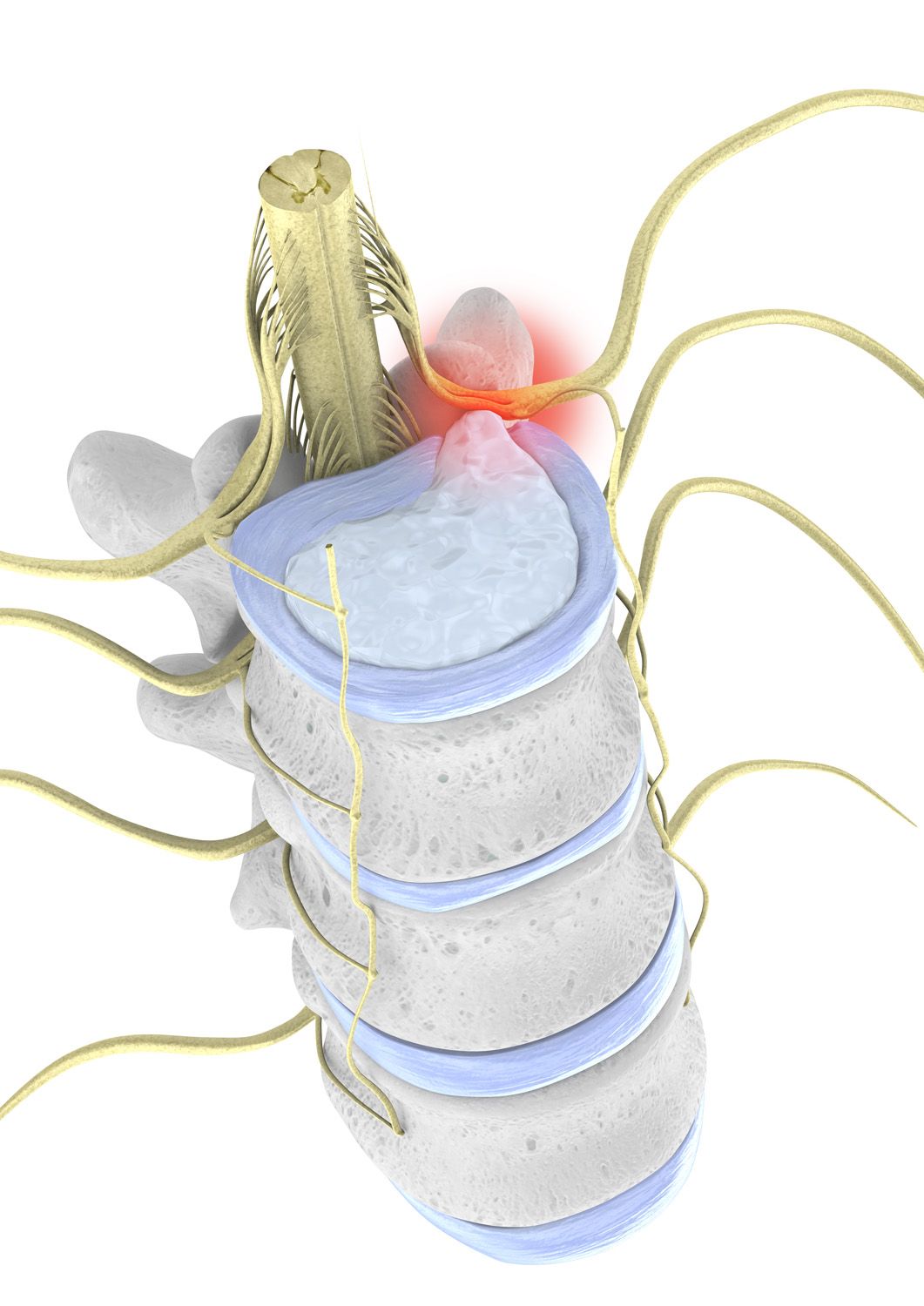 Image result for disc herniation