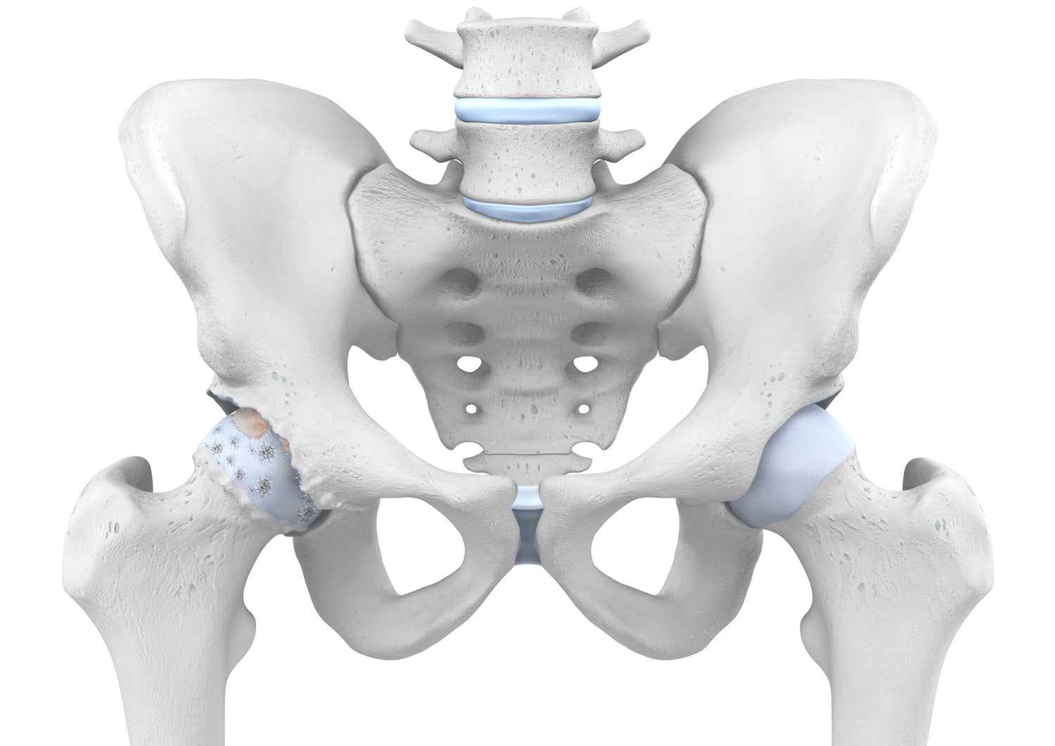 Schema of hip arthritis comparing hips