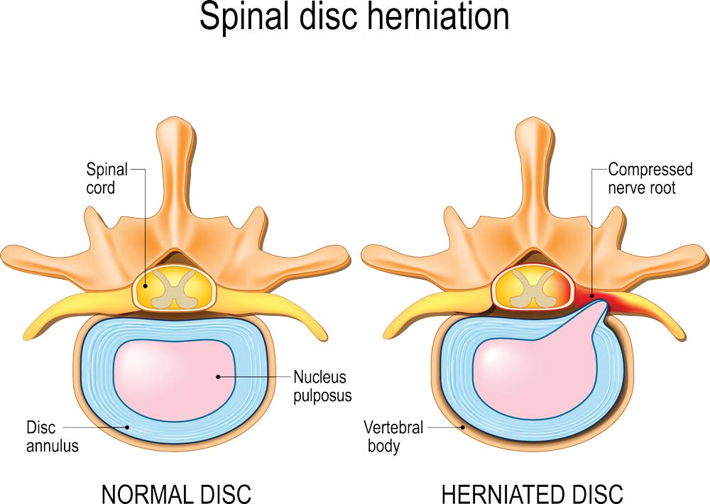 Image result for disc herniation