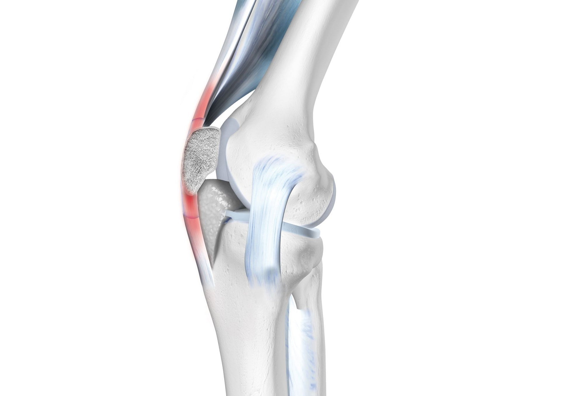 Patellar Tendonitis and Running: Symptoms, Causes and Research-Backed  Treatment Options - Runners Connect