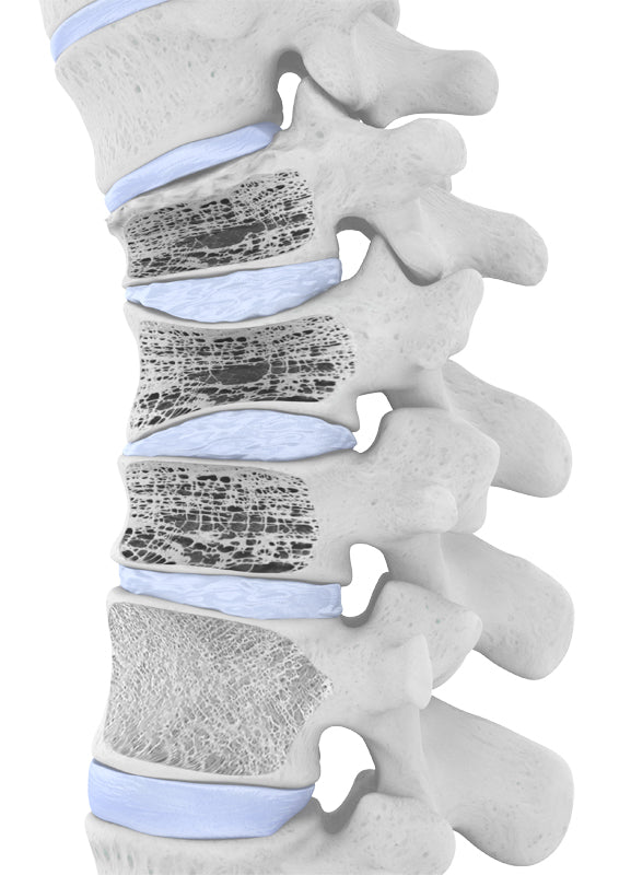 osteoporosis spine