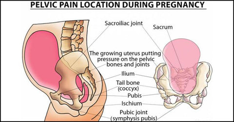Schéma squelettique de la localisation des douleurs pelviennes pendant la grossesse
