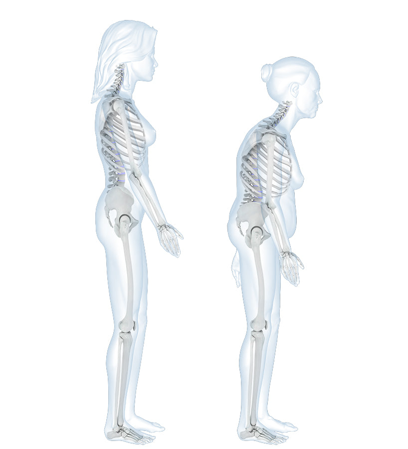 Skeletal diagram with two people, one standing straight and one with Dowagers hump