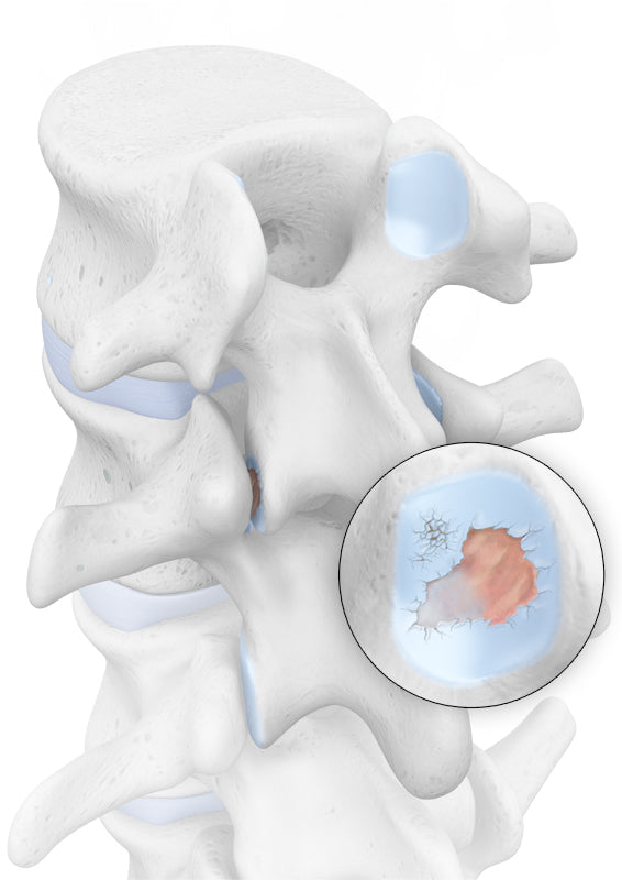 Skeletal diagram highlighting spondyloarthritis 