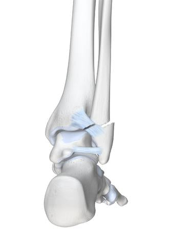 ankle fracture 