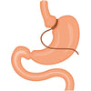 Adjustable Gastric Band