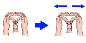 Phimosis stretching using 2 fingers