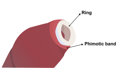 Phimosis rings for foreskin stretching