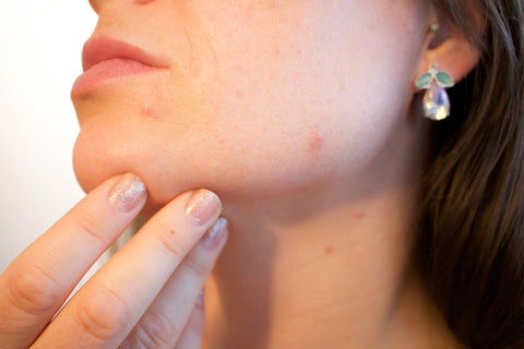 An image of a woman's face displaying acne.