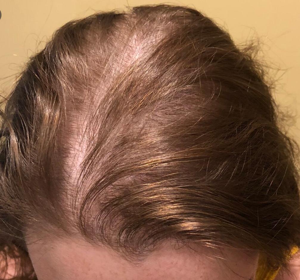 Fighting receding hairline using minoxidil for women – JJ ELLIE SKINCARE
