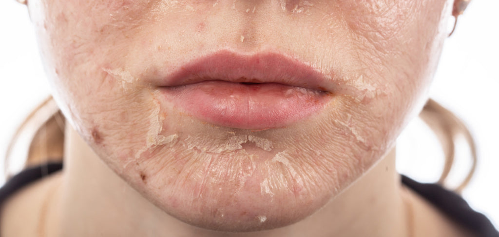 Image showing skin peeling from chemical peel procedure