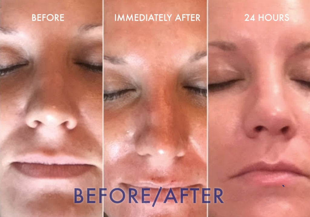 Before and after results of microneedling