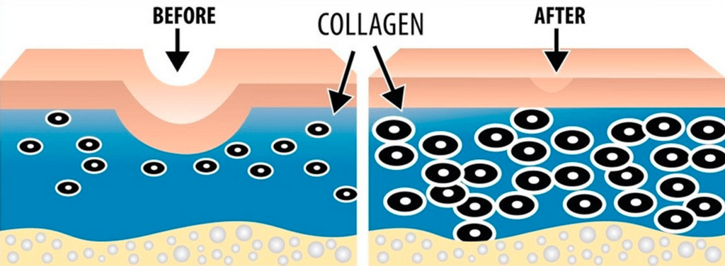 Image showing before and after microneedling