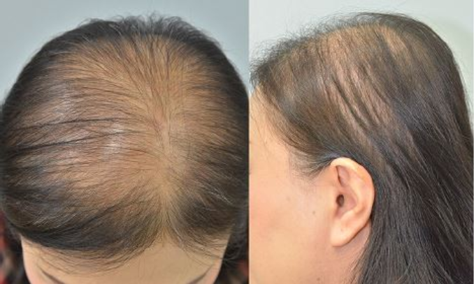 Hair loss in women