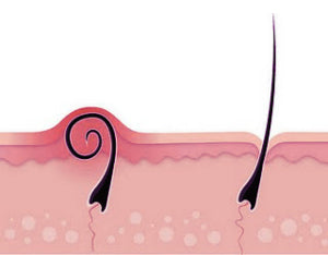 Ingrown Hairs Causes Prevention and Treatments  Eshaistic Blog