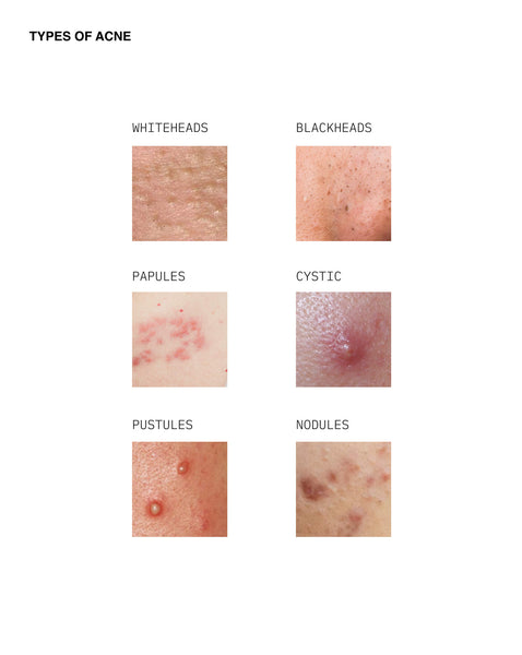 Types of acne: whiteheads, blackheads, cystic, papules, pustules, nodules