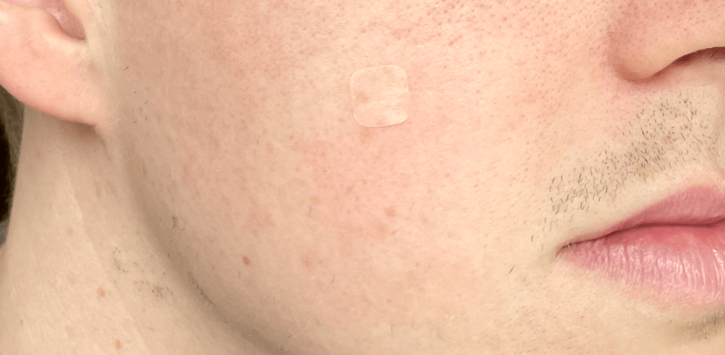 patches on skin