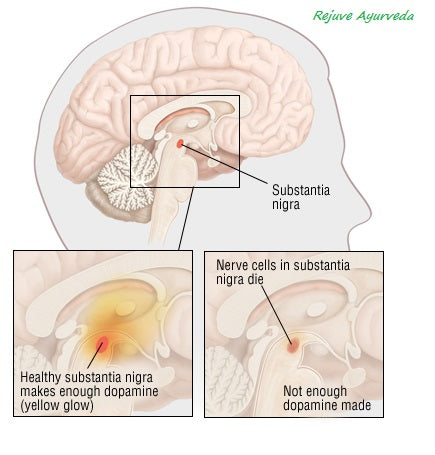 how color of brain changes in parkinsons, the change in size 