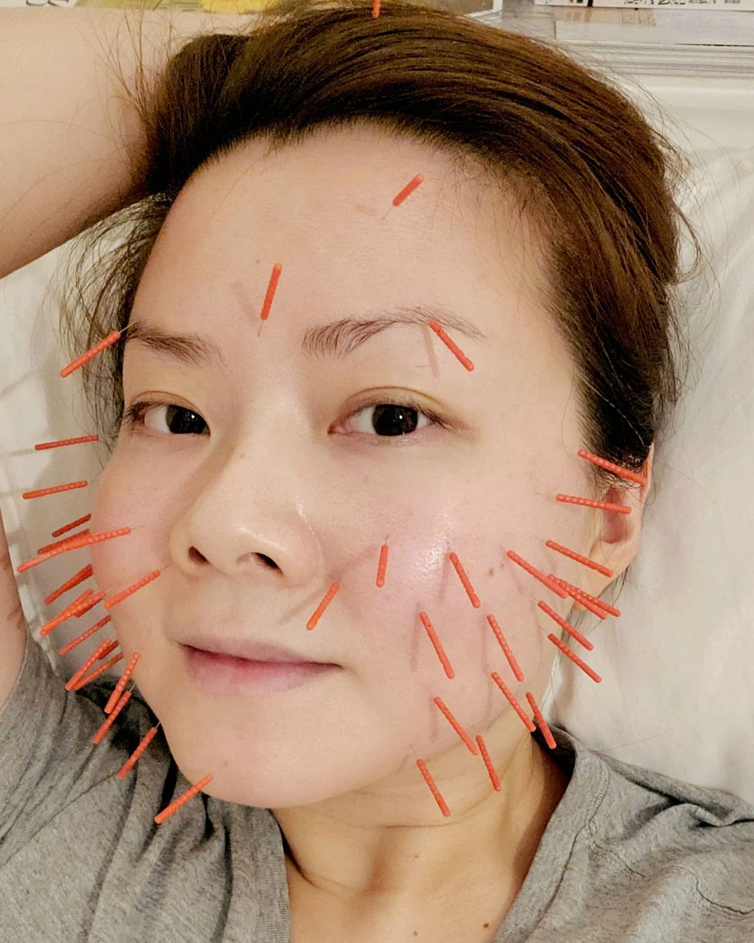 Facial Acupuncture Changed My Mind