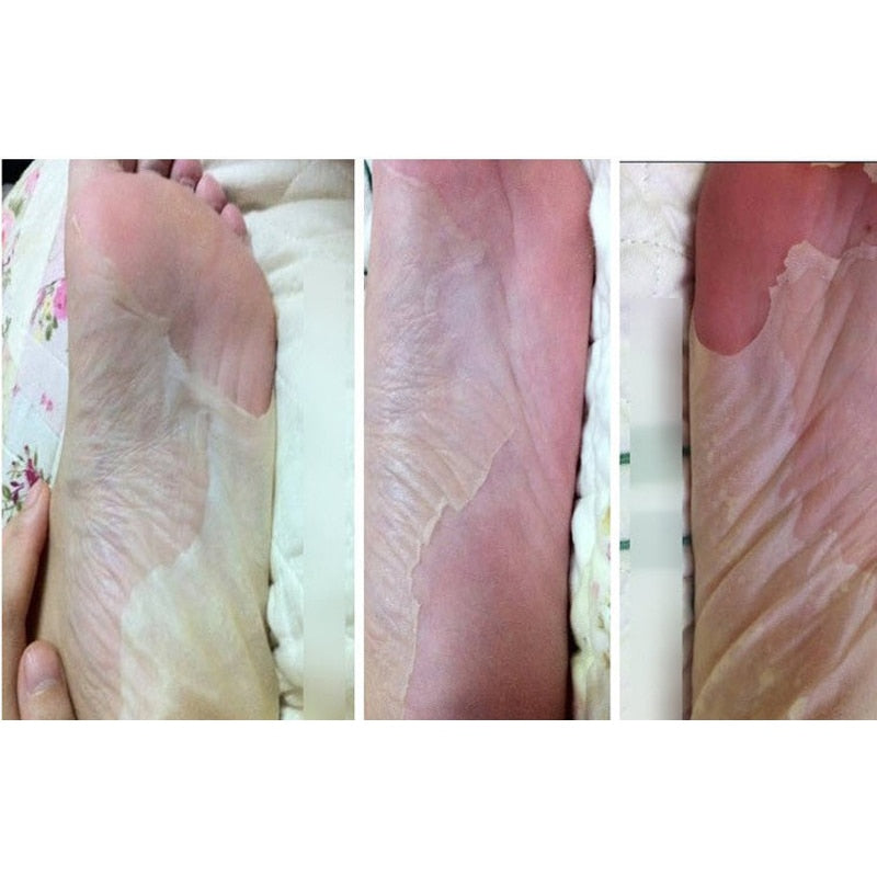 dead skin foot peel