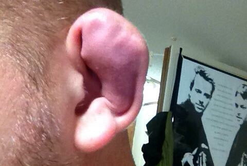 Serious Cauliflower Ear that needs to be drained