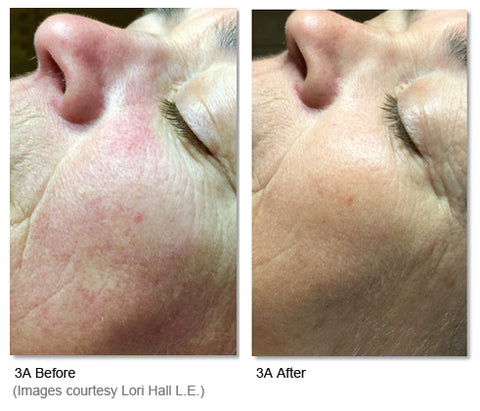 Before and After photos showing LED light therapy for wrinkles