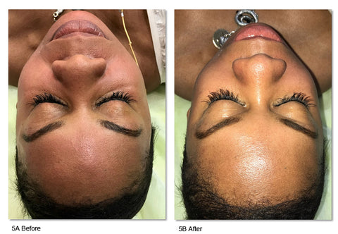 Before and after photos showing LED light therapy treatment and microneedling