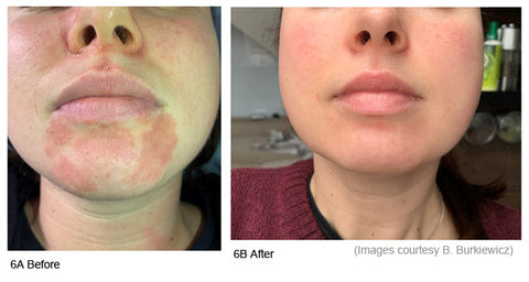 Before and after photos showing results of LED light therapy in treating skin redness and inflammation 