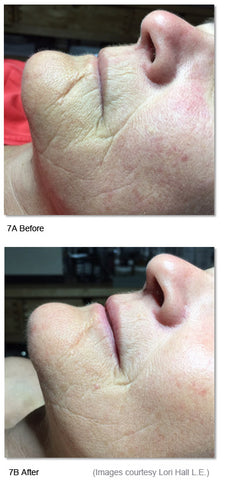 Before and after photos showing results of LED light therapy treatment for scarring