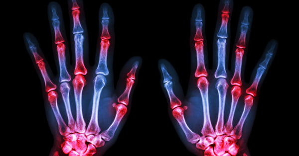 Image of a skeleton hand undergoing LED red light therapy