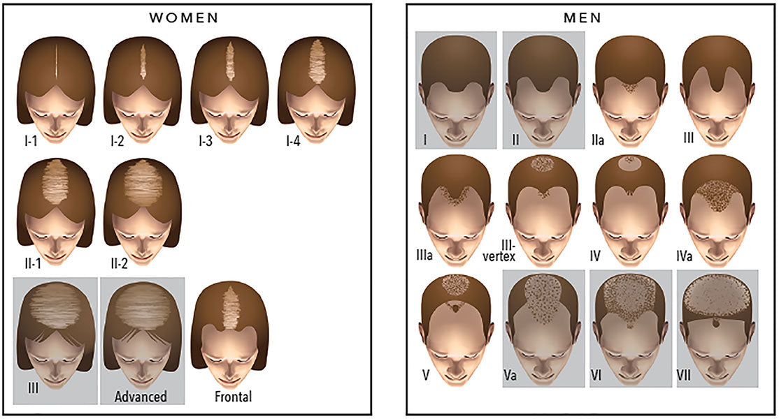 image showing hair loss patterns for men and women. highlighted images show which hair loss patterns are well-suited for red light therapy for hair growth.