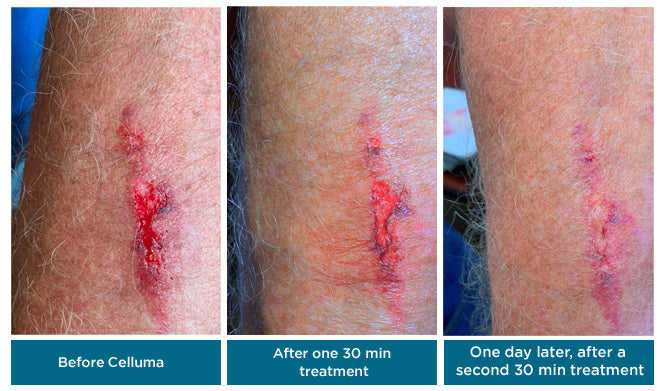 LED Light Therapy Wound Healing Results