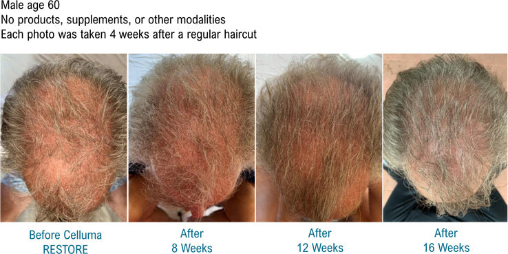 Laser Treatment for Hair Loss Does It Work