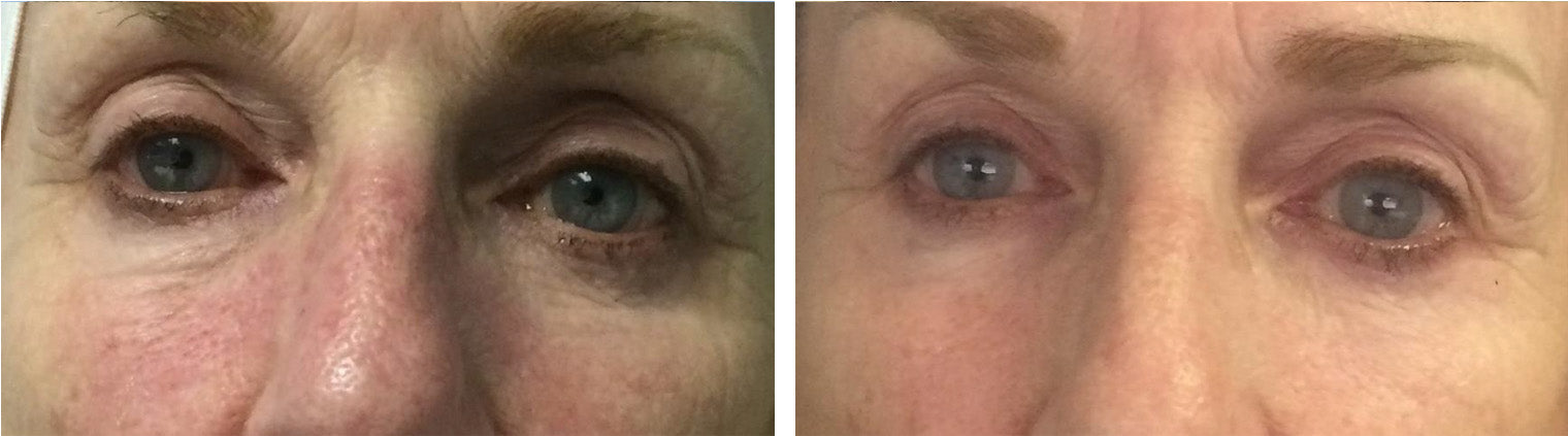 Amazing Before/After Results of the AntiAging Light Therapy of Celluma