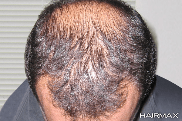 Hairmax Regrow Your Hair With The Ultimate Laser Treatment