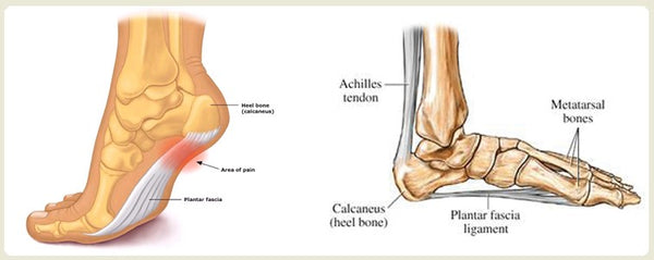 Plantar fasciitis (or a â€˜heel spurâ€™ or â€˜heel spur syndrome ...