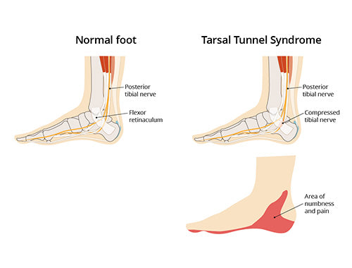 nerve pain in heel