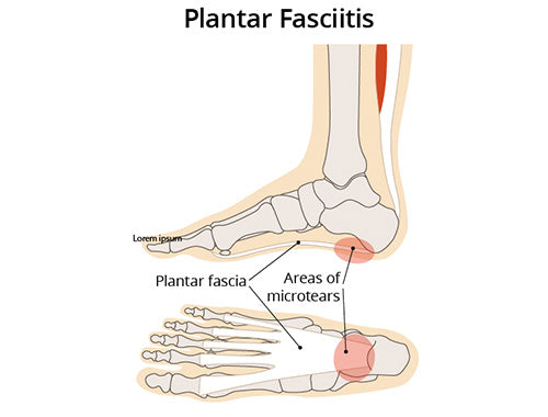 Foot Arch Pain: Causes and Treatment - Feet First Clinic