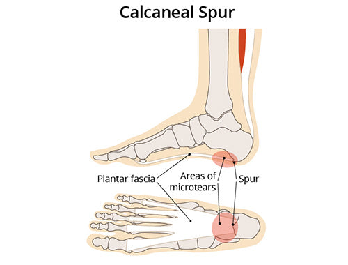 Treatment Options For Heel Pain?